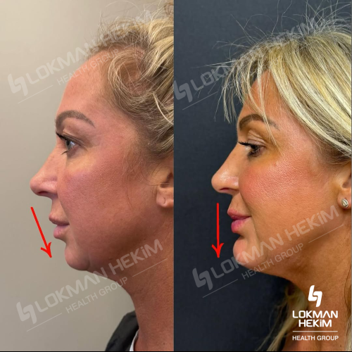 Jawline contouring Photo avant/après